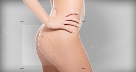 cuánto duran los implantes de glúteos