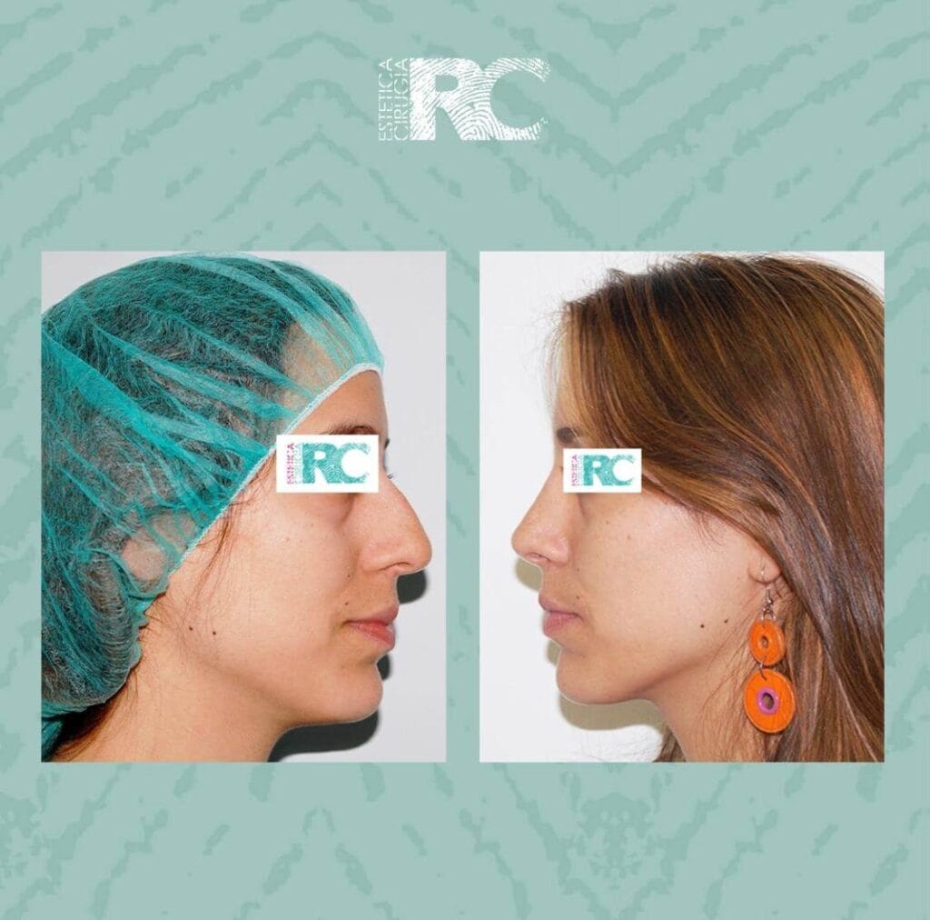 candidato rinoplastia