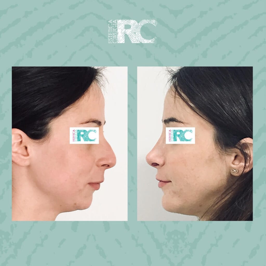 rinoplastia rc