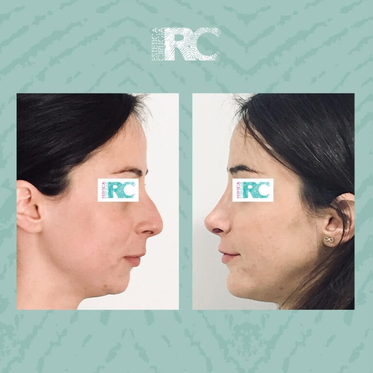 rinoplastia rc