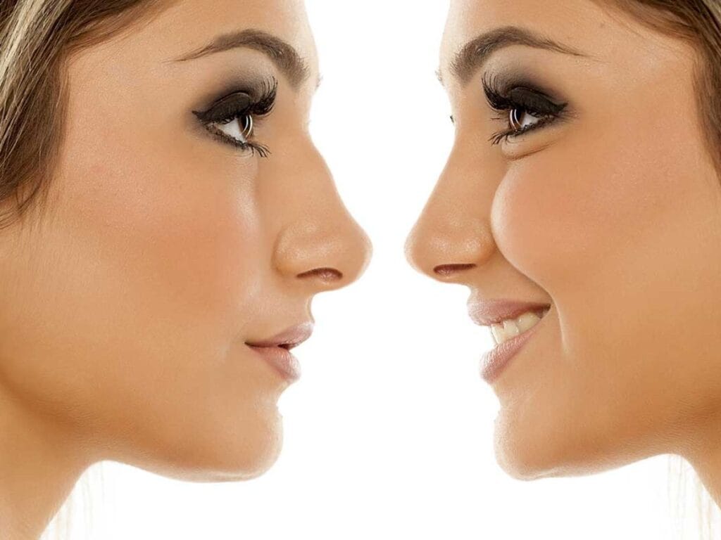 cirugia-rinoplastia-ultrasonica