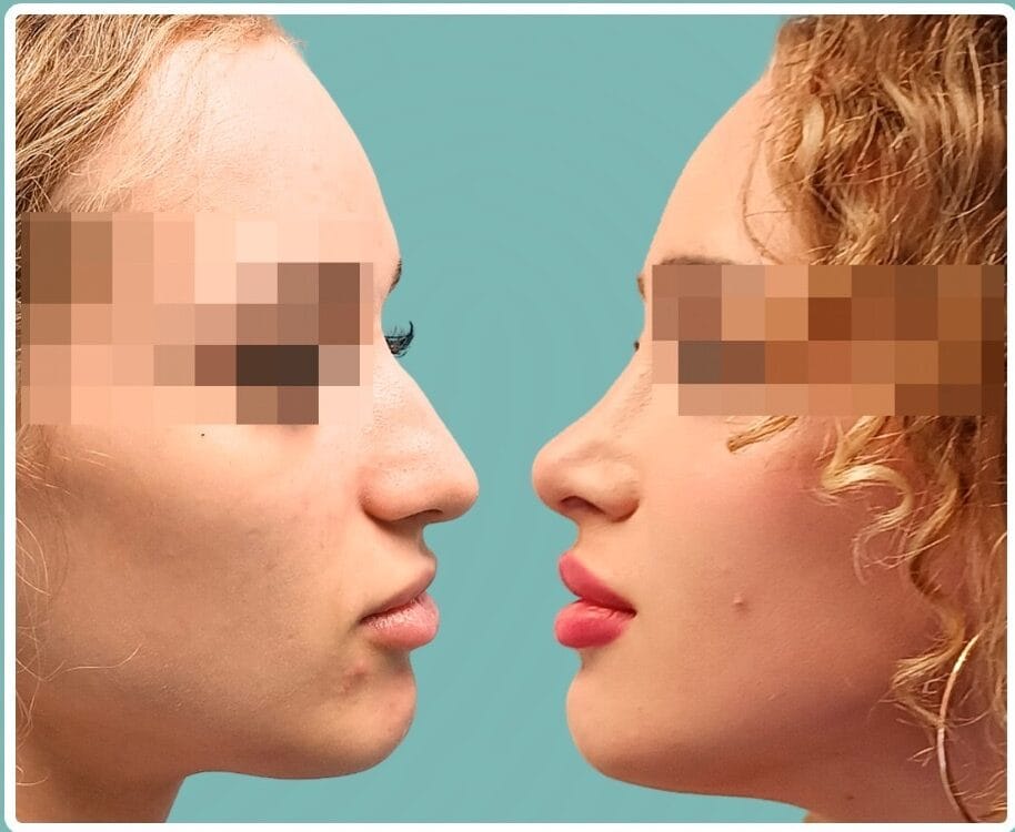 rinoplastia-ultrasonica-estructural